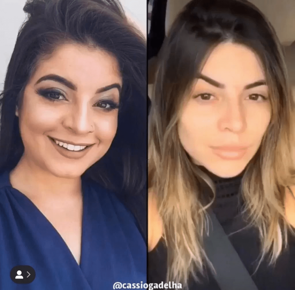 Influenciadora Gkay gasta fortuna para desfazer harmonização facial e ...